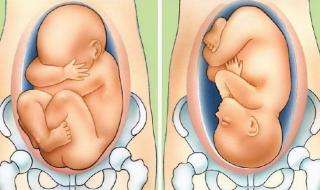 胎位不正怎么纠正